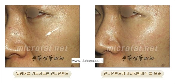 [두한성형외과의 경쟁력 미세지방이식] - [귀족수술과 인디언밴드 미세지방이식 안내 ③] 관련 이미지 11