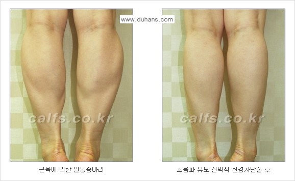 [두한성형외과 경쟁력 있는 종아리성형] - [종아리 축소 관련 흔한 질문과 답변들 1.] 관련 이미지 4