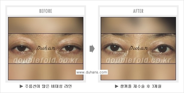 [두한성형외과 경쟁력 "극한 눈(쌍꺼풀) 재수술"] - ["극한 눈(쌍꺼풀) 재수술" 관련 질문과 답변 2.] 관련 이미지 6