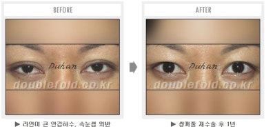 두한성형외과 쌍커풀 재수술 - 짝눈 눈매교정, 가성 안검하수 교정과 뒤밑트임 관련 이미지 42