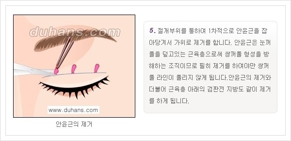 [두한성형외과 경쟁력 눈성형, 쌍꺼풀 수술] - [퀵쌍꺼풀(부분절개법)의 수술 안내] 관련 이미지 6