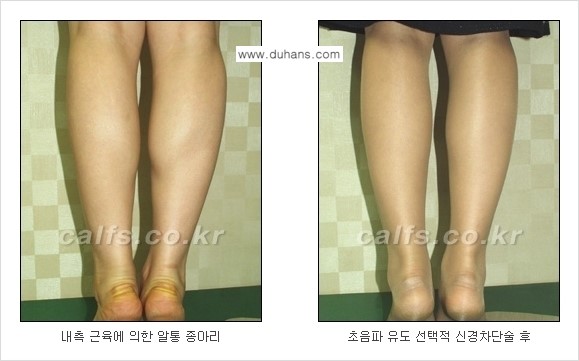 [두한성형외과 경쟁력 종아리성형] - [초음파 유도 선택적 신경차단술 안내 ③] 관련 이미지 11