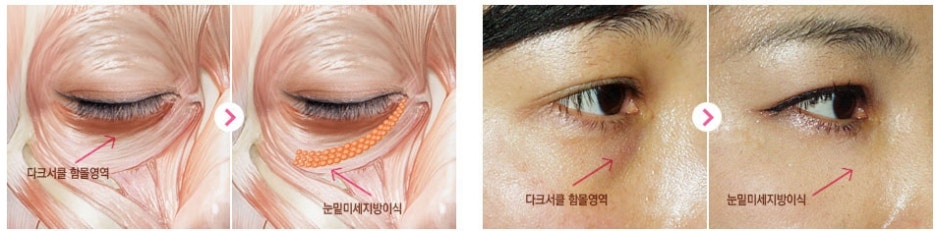 [두한성형외과 다크서클] - [다크서클 수술] 관련 이미지 2