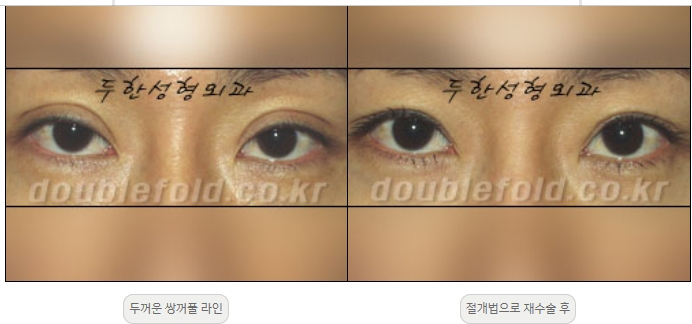 [Duhan Plastic Surgery Double Eyelid Revision] - [Thick Double Eyelid Line] image 11