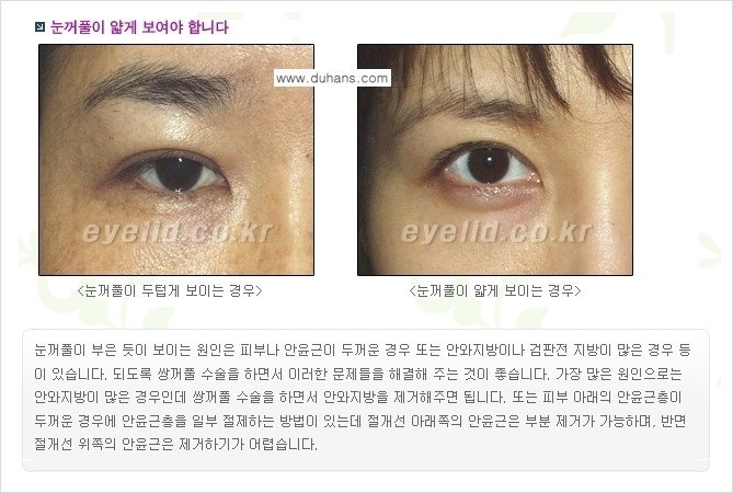 [두한성형외과 경쟁력 눈성형] - [퀵쌍꺼풀(부분절개법) 수술 안내] 관련 이미지 4