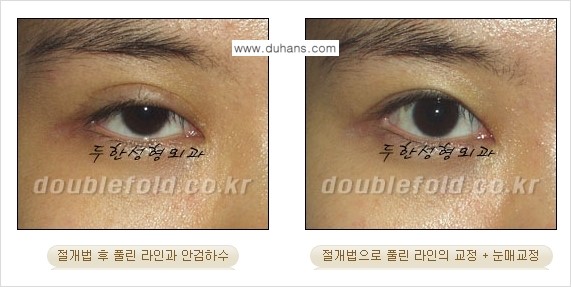 [두한성형외과 NO.1 경쟁력 눈성형] - [풀린 쌍꺼풀 절개법으로 교정하는 방법] 관련 이미지 3