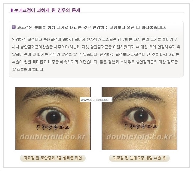 [두한성형외과 경쟁력 쌍꺼풀 재수술(극한 재수술)] - [쌍꺼풀 재수술에서 극복해야 할 여러 가지 상황과 문제점들 안내] 관련 이미지 9