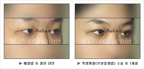 [두한성형외과 쌍커풀수술] - [눈성형 방법에 대한 자주하는 질문과 답변] 관련 이미지 121