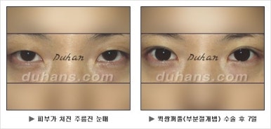 Best Place for Double Eyelid Revision Surgery, Duhan Plastic Surgery - Partial Incision Eye Revision Surgery image 16