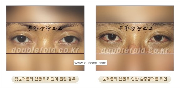 [두한성형외과 경쟁력 눈성형] - [ #꺼진눈꺼풀성형 #함몰눈꺼풀 의 쌍꺼풀 라인의 교정 안내 ②] 관련 이미지 3