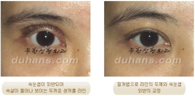 두한성형외과 눈재수술 - 쌍꺼풀 재수술 방법 관련 이미지 45