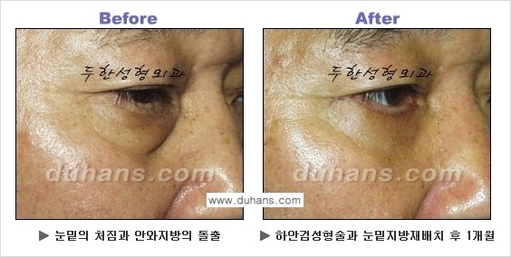 [두한성형외과의 상큼하고 환한 젊은 눈매완성] - [하안검 성형술 ①] 관련 이미지 11