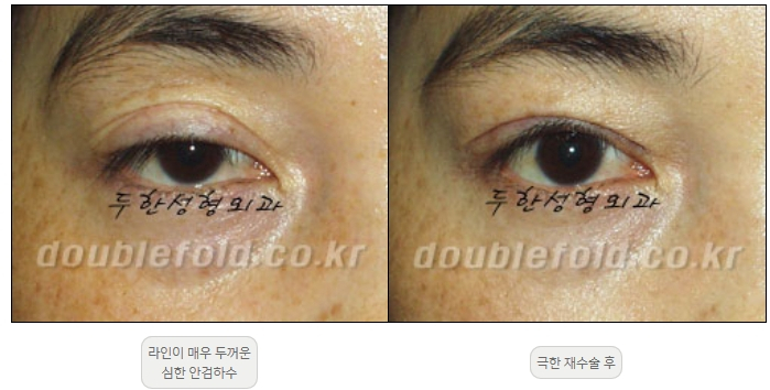 [Double Eyelid Surgery, Duhan Plastic Surgery] - [Extreme Revision Eye Surgery to Correct a Damaged Line] image 16