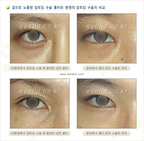 [두한성형외과 NO.1 눈성형] - [몽고주름 관련 흔한 질문과 답변] 관련 이미지 3
