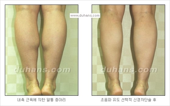 [두한성형외과 경쟁력 멀티종아리성형] - [종아리 퇴축수술 방법들의 문제점] 관련 이미지 12
