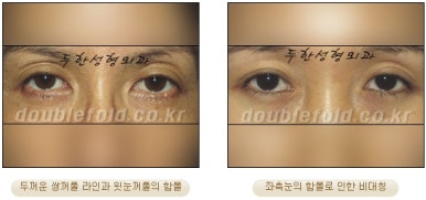 [Duhan Plastic Surgery Double Eyelid Revision Surgery] - [Correcting the Double Eyelid Line in Sunken Eyelids] image 2