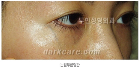 두한성형외과 보기싫은 혈관제거 - 눈밑혈관, 손과 팔의 혈관확장증 치료 관련 이미지 2
