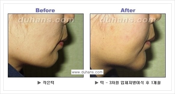 [두한성형외과 경쟁력 미세지방이식] - [아름다운 얼굴선 - 무턱, 오목턱, 비대칭턱 지방이식 안내] 관련 이미지 14