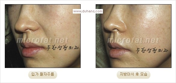 [두한성형외과 경쟁력 주름성형] - [입가주름과 코옆 팔자주름제거 지방이식 시술의 효과] 관련 이미지 11