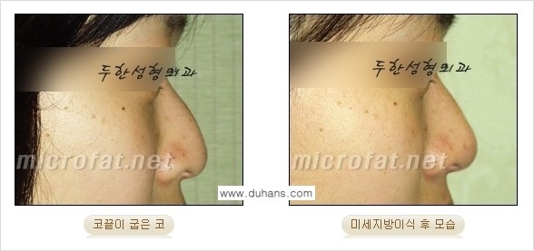 [두한성형외과 경쟁력 미세지방이식] - [미세지방이식을 이용한 코성형의 장점 안내] 관련 이미지 19