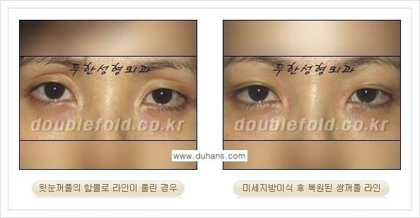 [두한성형외과 경쟁력 쌍꺼풀 재수술(극한 재수술)] - [라인이 풀렸을 경우의 쌍꺼풀 재수술 안내 ②] 관련 이미지 9
