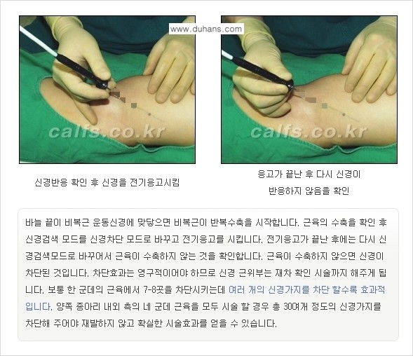 [두한성형외과 경쟁력 종아리성형] - [초음파 유도 선택적 신경차단술 안내 ②] 관련 이미지 11