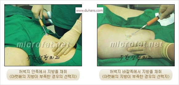 [두한성형외과 경쟁력 안면윤곽 교정] - [자연스럽고 균형있는 턱으로의 복원 미세지방이식과 간편 사각턱 보톡스 안내] 관련 이미지 29