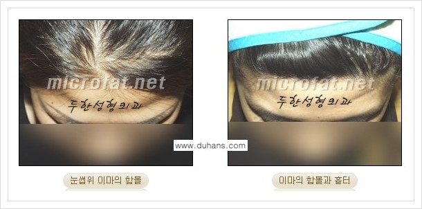 [두한성형외과 경쟁력 미세지방이식] - [부드럽고 아름다운 얼굴 윤곽선 이마(전두부) 미세지방이식] 관련 이미지 1