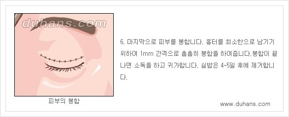 [두한성형외과 경쟁력 눈성형] - [상큼하고 환한 눈매! 상안검 성형(윗눈꺼풀 처짐) 안내] 관련 이미지 6