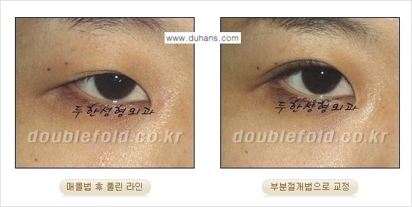 [두한성형외과 경쟁력 눈성형] - [풀린 쌍꺼풀 라인 재수술의 여러 가지 방법 안내] 관련 이미지 7