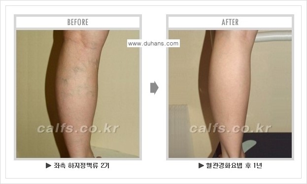 [두한성형외과 경쟁력 정맥류 치료] - [하지정맥류 사진 자료 안내 1.] 관련 이미지 5