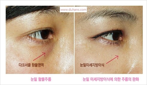 [두한성형외과 경쟁력 눈밑성형] - [눈밑 미세지방이식의 이해도 안내] 관련 이미지 15
