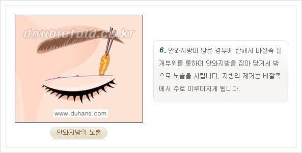 [두한성형외과 경쟁력 쌍꺼풀 재수술, 극한 재수술] - [쌍꺼풀 재수술의 과정 안내 1.] 관련 이미지 17