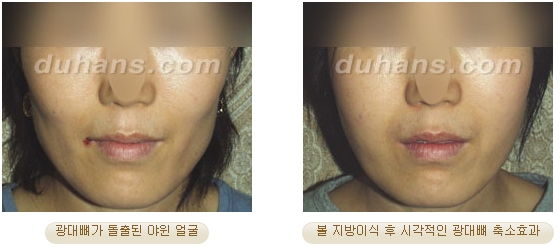 [두한성형외과 얼굴자가지방이식] - [볼살, 이마, 측두부] 관련 이미지 16