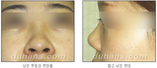 [두한성형외과 얼굴자가지방이식] - [코지방이식] 관련 이미지 3