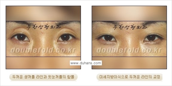 [두한성형외과 경쟁력 눈성형] - [미세지방이식으로 두꺼운 쌍꺼풀 라인의 교정 방법 안내] 관련 이미지 3