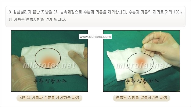 [두한성형외과의 경쟁력 있는 지방이식] - [입가주름, 팔자주름 미세지방이식 1.] 관련 이미지 4
