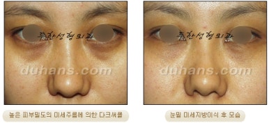 두한성형외과 눈밑성형 - 눈밑지방제거, 눈밑주름, 눈밑지방재배치 관련 이미지 74