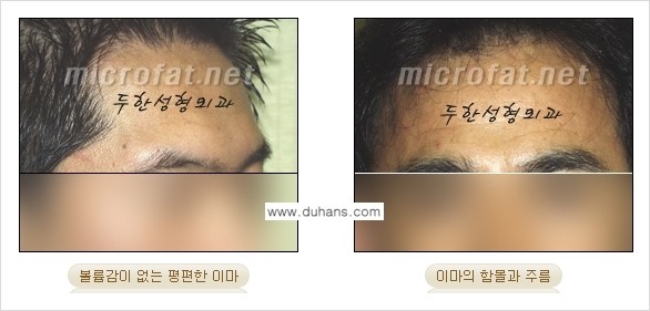[두한성형외과의 경쟁력 미세지방이식] - [이마 미세지방이식 안내 ①] 관련 이미지 4