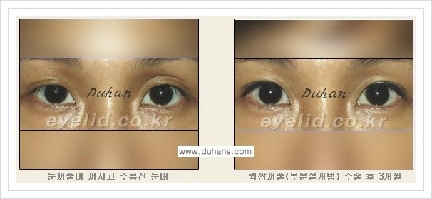 [두한성형외과 경쟁력 쌍꺼풀 재수술, 극한 재수술] - [퀵쌍꺼풀(부분절개법) 안내] 관련 이미지 6