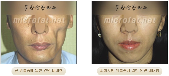[DuHan Plastic Surgery Face Fat Grafting] - [Cheek Fat Grafting] image 4