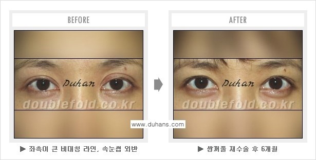 [두한성형외과 경쟁력 쌍꺼풀 재수술] - [재수술 관련 질문과 답변 안내] 관련 이미지 13