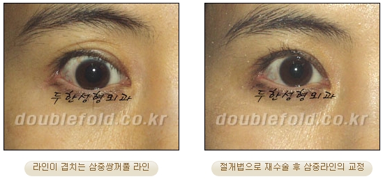 두한성형외과 쌍커풀재수술 - 삼중 쌍커풀 라인 교정 관련 이미지 22