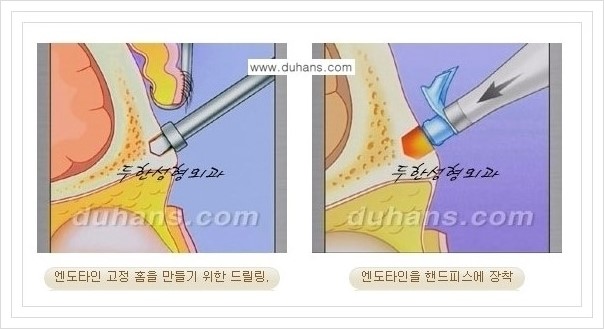 [두한성형외과 경쟁력 주름성형] - [회복과 일상으로의 복귀가 빠른 눈썹거상, 이마주름 엔도타인 리프팅] 관련 이미지 10