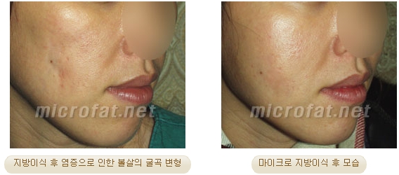 [두한성형외과 지방이식] - [타병원의 지방이식 부작용 교정] 관련 이미지 24
