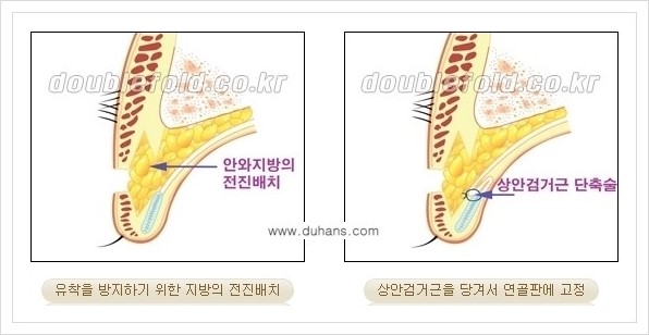 [두한성형외과 경쟁력 쌍꺼풀 재수술(극한 재수술)] - [안검하수(졸리운 눈매) 교정 안내 2.] 관련 이미지 5