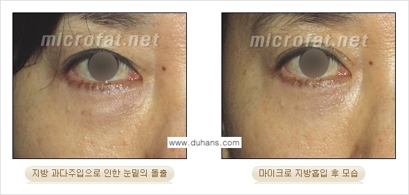 ​​​​[두한성형외과 경쟁력 미세지방이식] - [지방이식 부작용 - 지방이식 과다주입, 과다생착의 얼굴 모양에 대한 안내] 관련 이미지 4