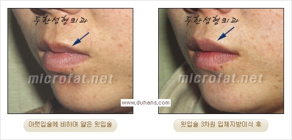 ​​​[두한성형외과 경쟁력 지방이식] - [지방이식을 이용한 입술성형 안내] 관련 이미지 19