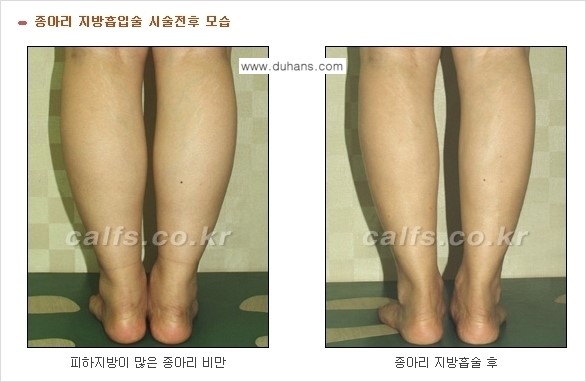 ⁠⁠[두한성형외과 경쟁력 멀티종아리성형] - [지방흡입이 필요한 종아리 비만 안내] 관련 이미지 5