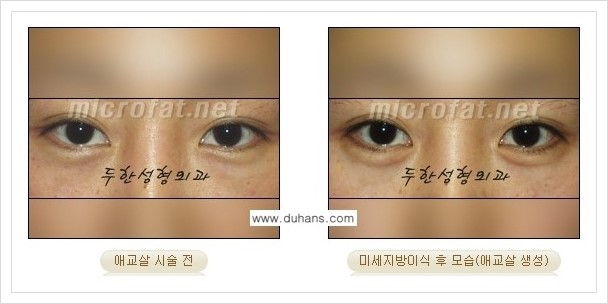 [두한성형외과 경쟁력 눈밑성형] - [눈밑 애교살 시술을 위한 미세지방이식] 관련 이미지 7